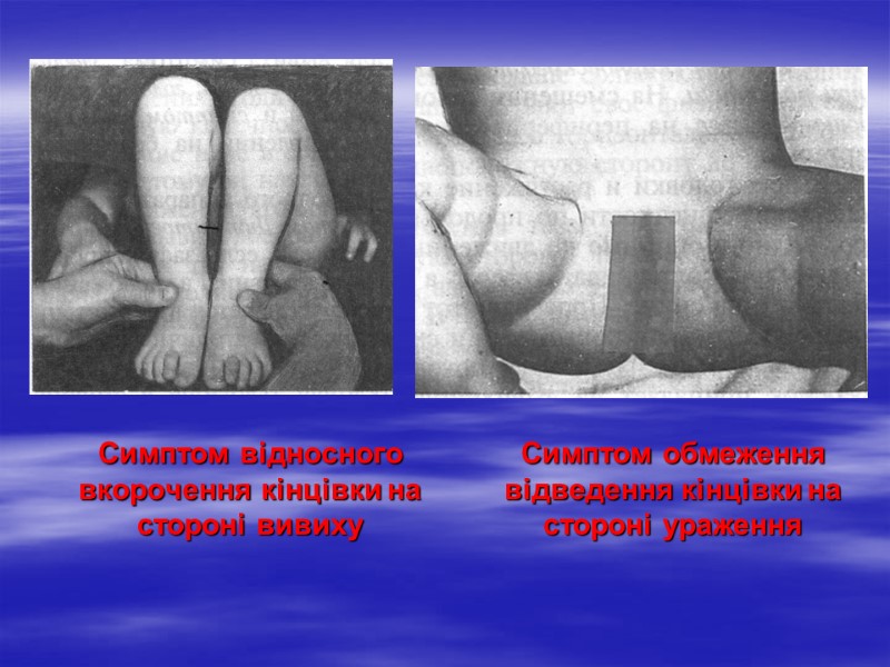 Симптом відносного вкорочення кінцівки на стороні вивиху   Симптом обмеження відведення кінцівки на